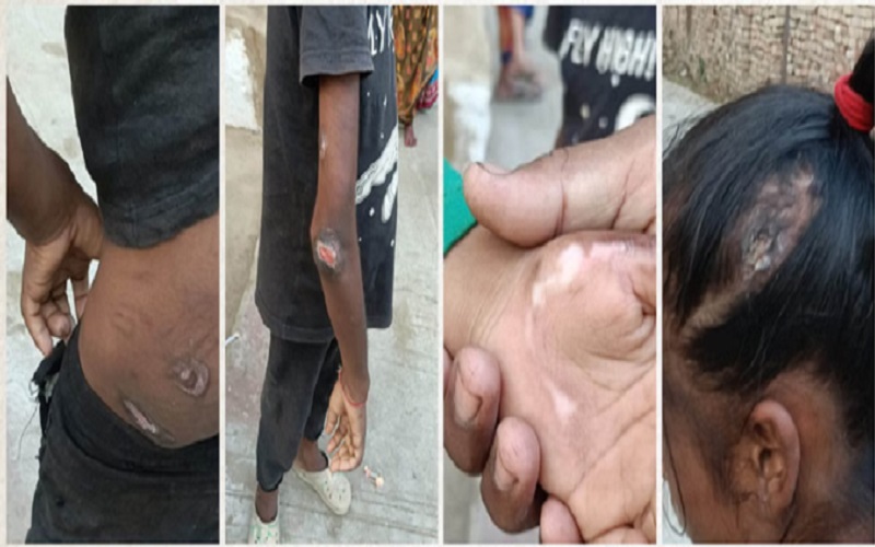 कानपुर में अमानवीयता की हद! चाची ने मासूम बच्चों को हीटर से जलाया, पुलिस भी देख कांप उठी