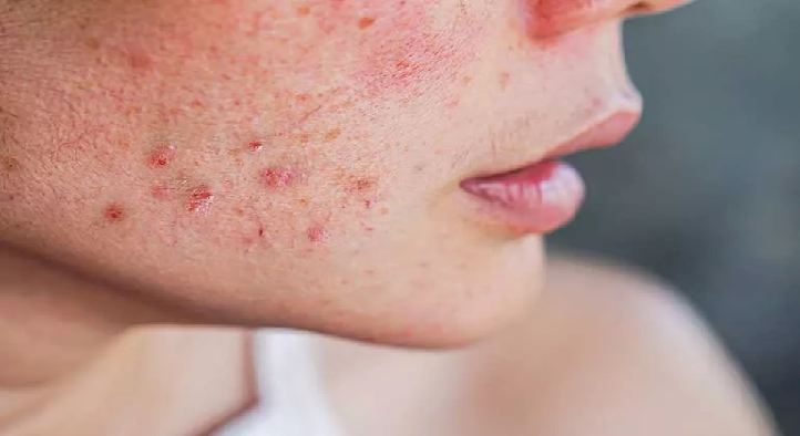 चेहरे पर अचानक निकलने वाले पिंपल्स हो सकते हैं हार्मोनल बदलाव का संकेत