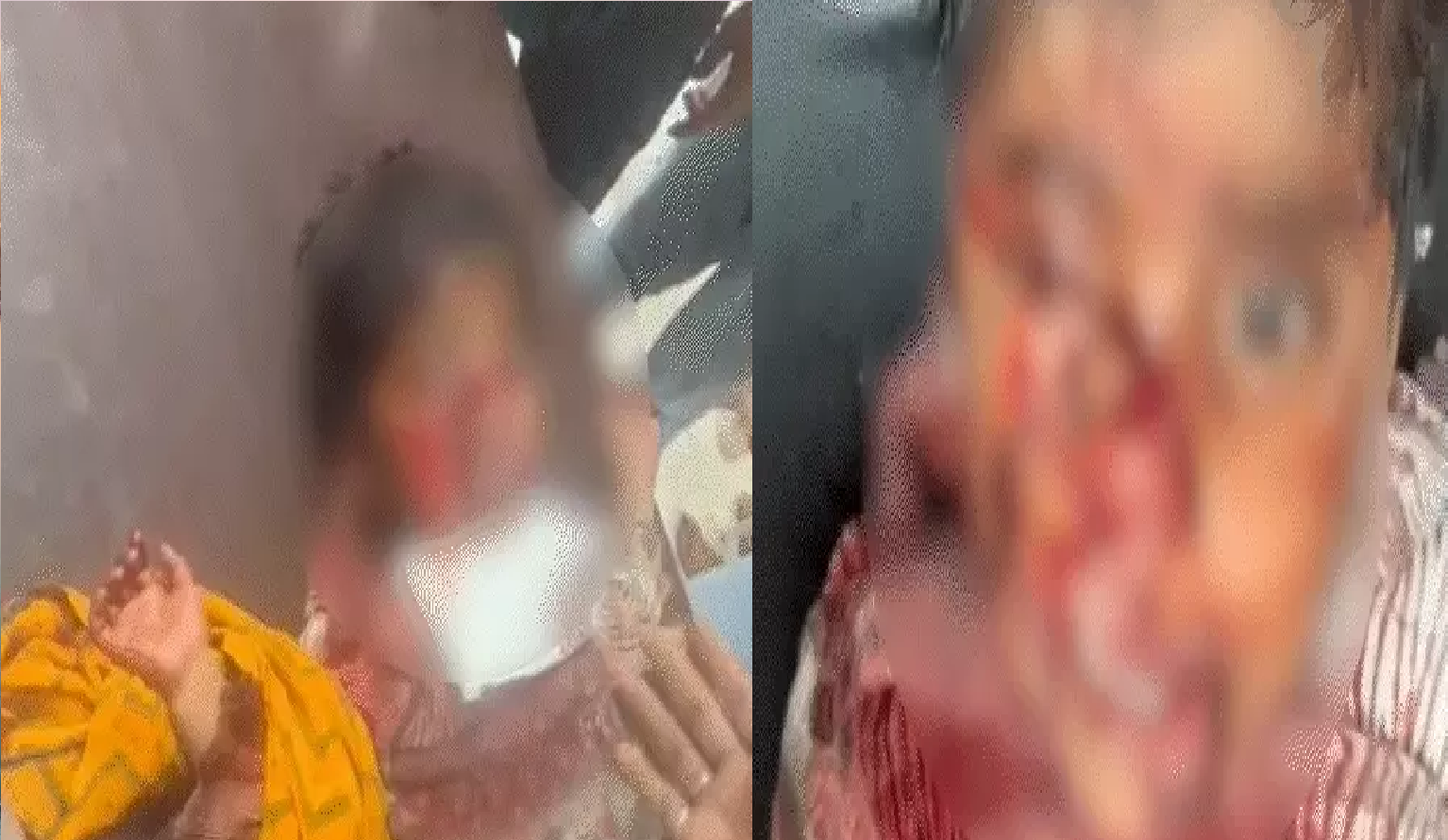 उज्जैन में आवारा कुत्ते का खौफनाक हमला, 3 साल की मासूम का चेहरा बुरी तरह नोचा; 55 टांके लगे