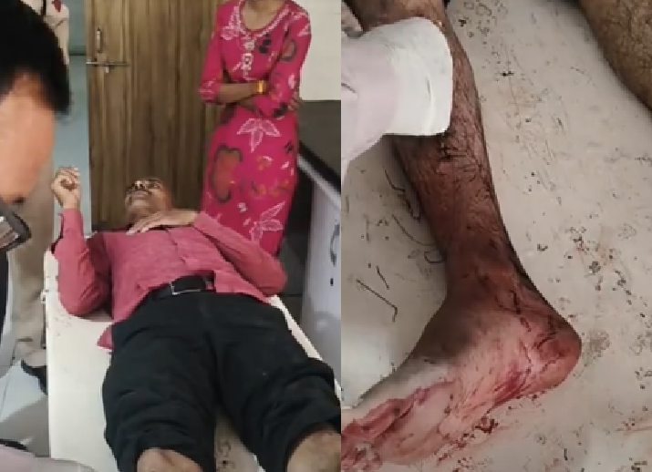 बुजुर्ग और बाइक के ऊपर से गुजर गया कंटेनर, फिर भी बच गई जान; पैर में गंभीर चोट, लगे 20 टांके