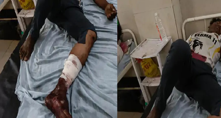 ट्रैक्टर चलाने के विवाद में युवक पर हमला: लाठी-डंडों से पीटकर किया घायल, पैर में फ्रैक्चर
